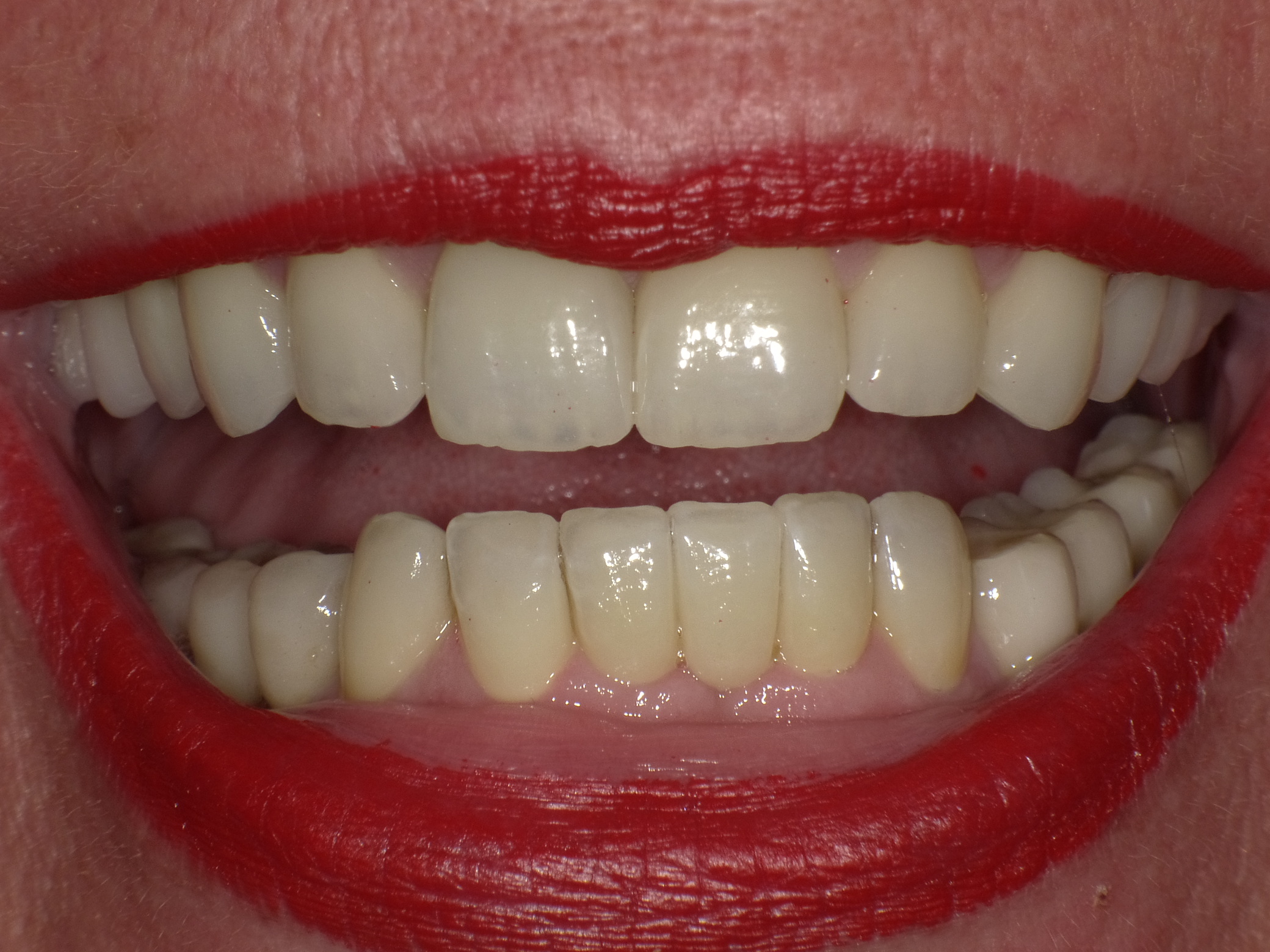 Korrektur durch vollkeramische Kronen und Venneers im Smile-Design 